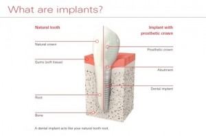 what-is-implant